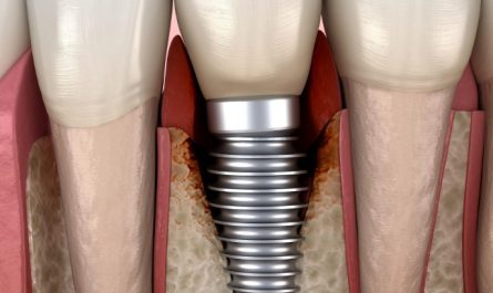 Dreaming of Dental Implants