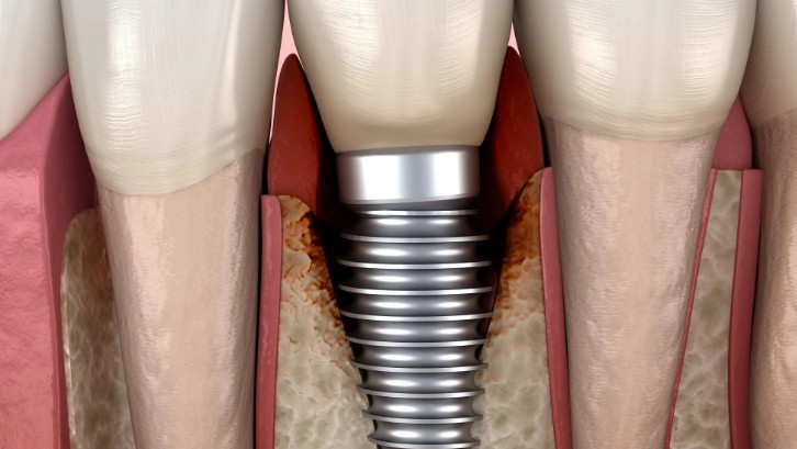 Dreaming of Dental Implants