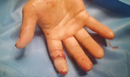 Dreaming of a Broken Finger