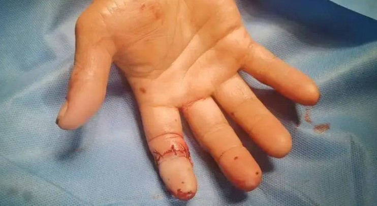 Dreaming of a Broken Finger