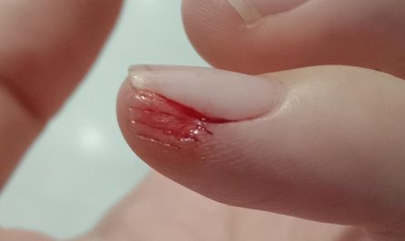 Dreaming of Hand Injuries
