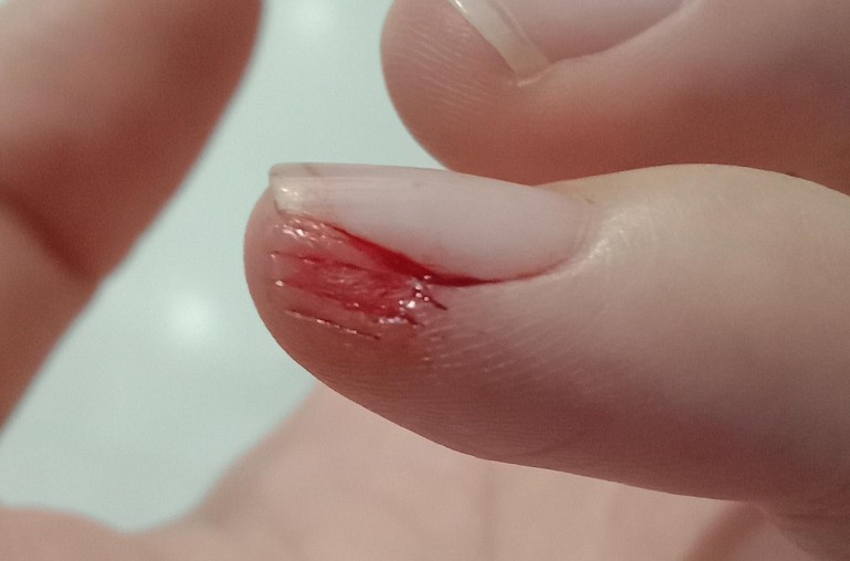 Dreaming of Hand Injuries