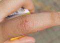 Dreaming of Finger Injuries