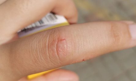 Dreaming of Finger Injuries