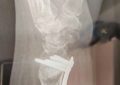 Dreaming of a Wrist Fracture