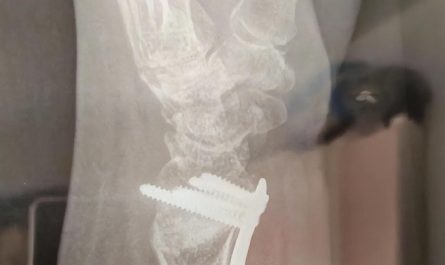 Dreaming of a Wrist Fracture