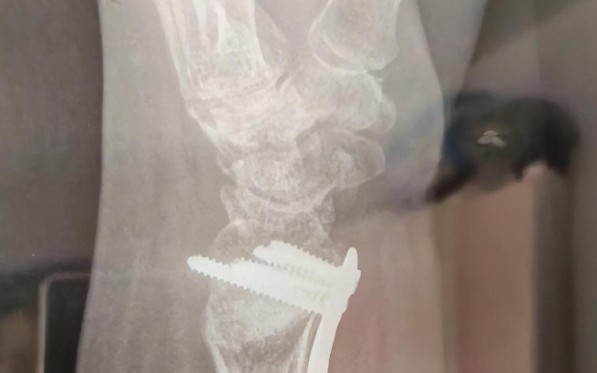 Dreaming of a Wrist Fracture