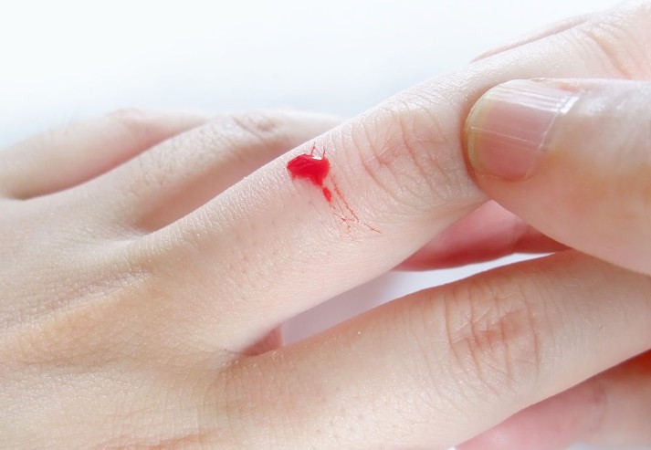Dreaming of Finger Bleeding