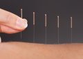 Dreaming of acupuncture clinic